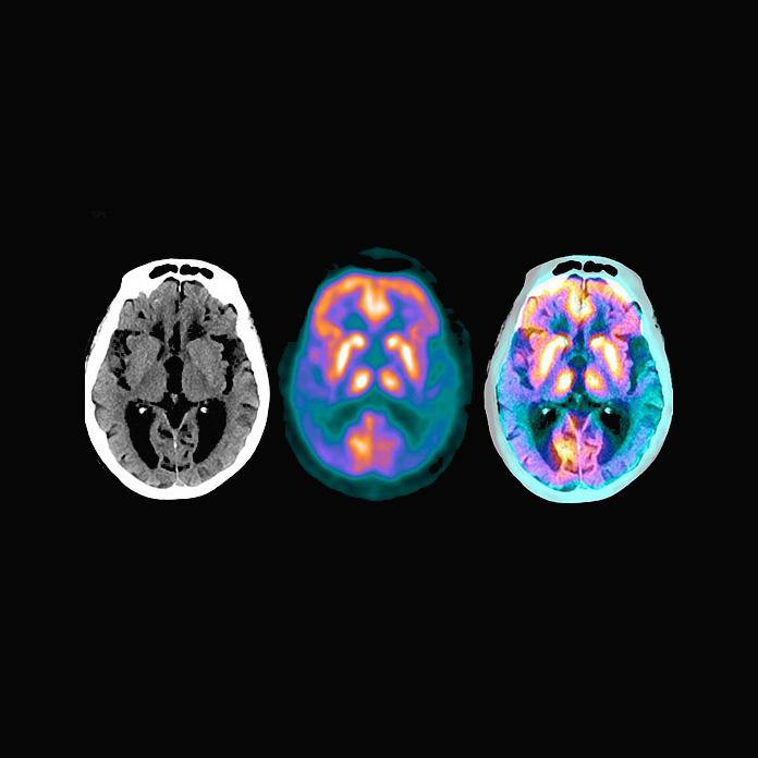 How to Cut Your Risk of Alzheimer's Disease in Half