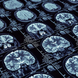 Overcoming the Effects of Inflammation and Oxidative Stress on Your Brain Health